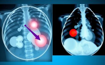 Ritrai mammogram yang menunjukkan kontras warna untuk mendeteksi benjolan di jaringan payudara padat.